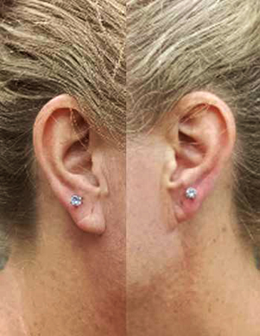 Uper Lobe Bali Piercing 1